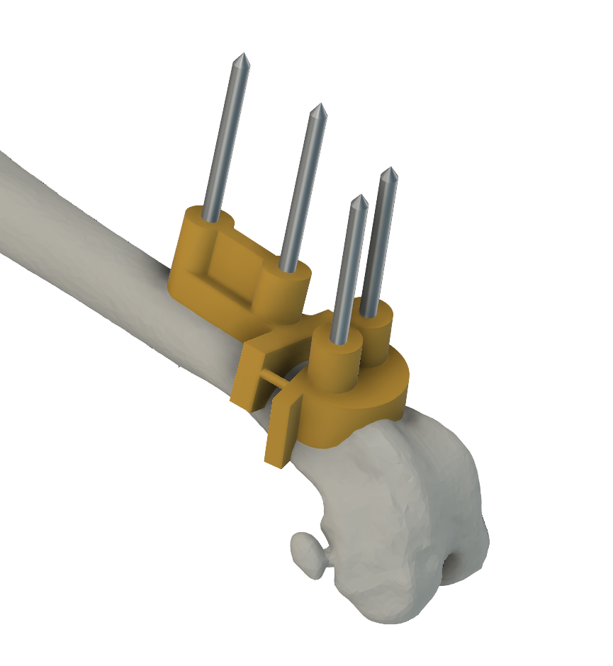 Surgical guide fitted on a femur bone model