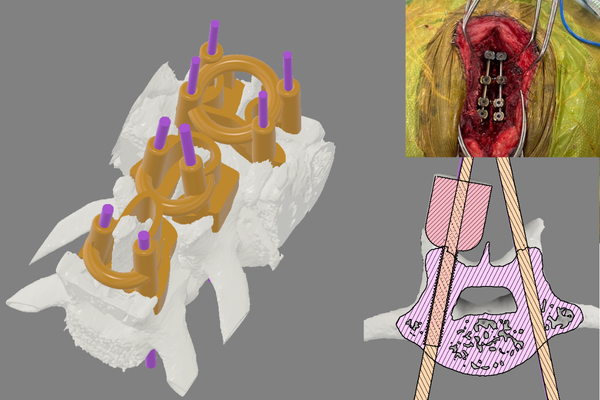 Spinal surgery 3D printed guide collage
