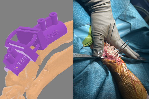 Angular limb deformity 3D printed guide and surgical procedure