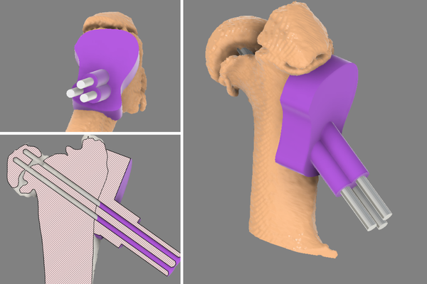 Fracture repair 3D printed surgical guide collage